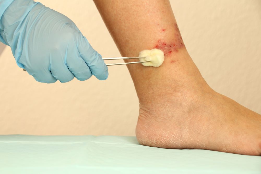 Chronic Venous Insufficiency: 5 Most Common Causes
