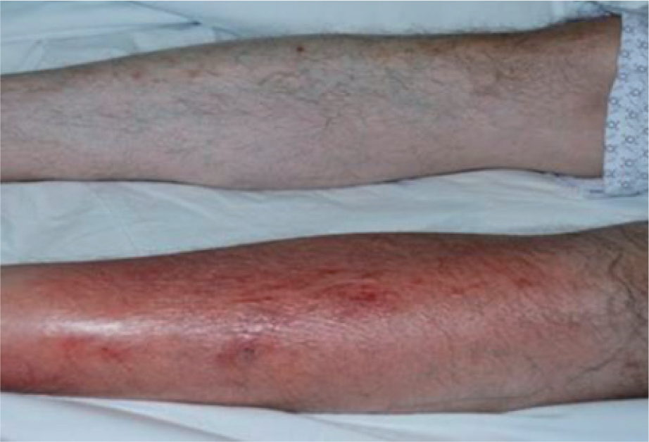 Reducing Cellulitis with Compression Therapy